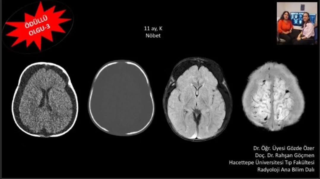 📣📣📣Haftanın ödüllü olgu sorusu yayınlandı.
Yanıtlarınızı www.tnrd.org.tr adresinden bekliyoruz.