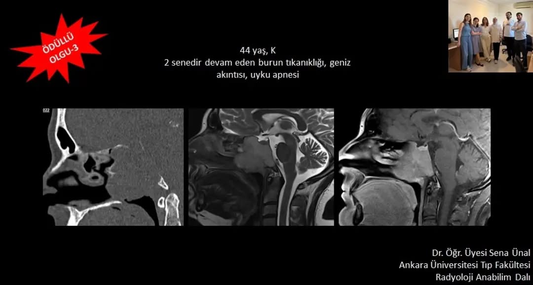 📣📣📣Haftanın ödüllü olgu sorusu yayınlandı.
Yanıtlarınızı www.tnrd.org.tr adresinden bekliyoruz.